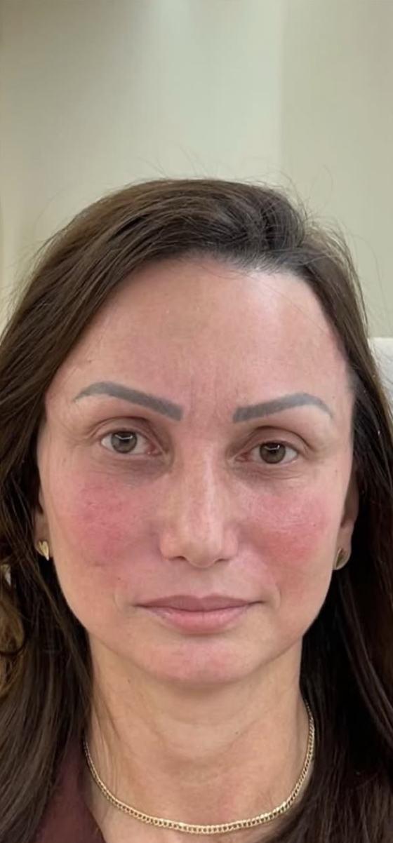 Depois do procedimento
