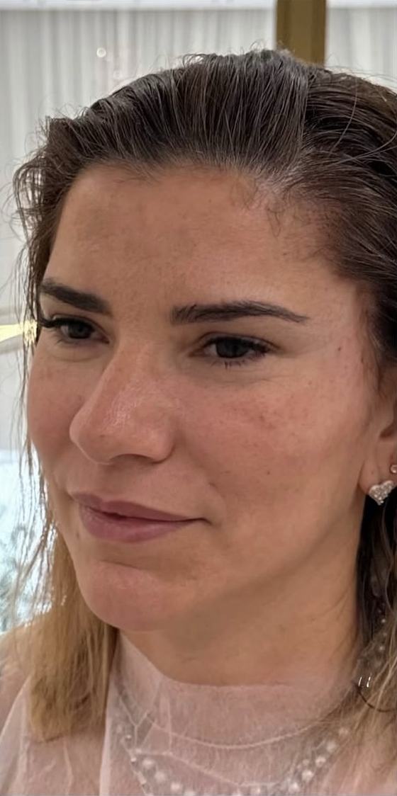 Depois do procedimento